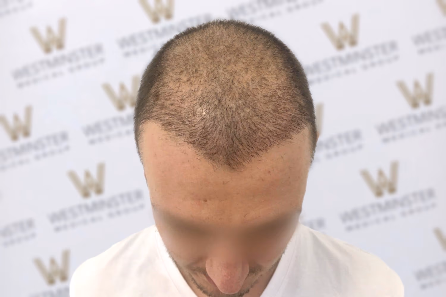 Top-down view of a person's head showing early stages of hair regrowth after male pattern baldness, against a backdrop with a repeated "w" logo. The person has short, sparse hair on