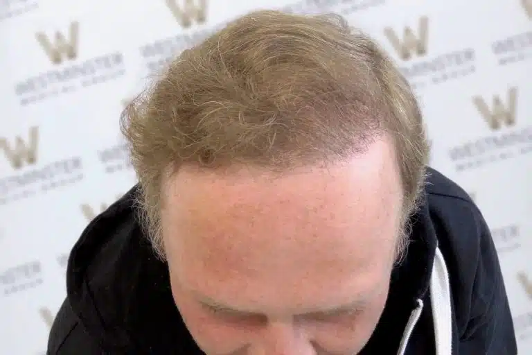Top view of a man's head showing thinning hair and a balding crown, possibly in need of hair replacement, with a background of a wall featuring the Westminster Hotel logo.