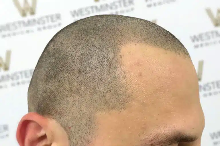 Close-up of a person's head showing a partially shaved scalp with visible hair stubble and a clear demarcation line, set against a backdrop featuring the "westminster" logo, hinting at