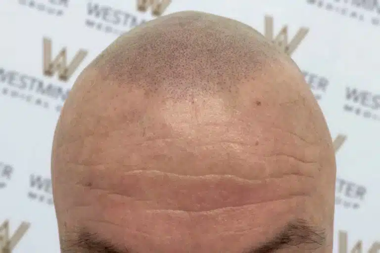 Close-up image of a bald head with visible hair follicles and natural skin creases, representing female hair loss. Background features a logo with "western western.