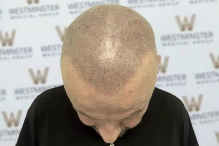 Top view of a bald man's head undergoing hair regrowth, against a backdrop with a repetitive "westminster" logo pattern.