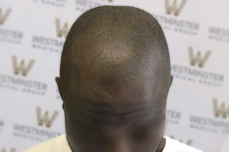Close-up photo of the top of a person's head, showing signs of female hair loss, against a backdrop with "Westminster" and "www" logos. The person's face is not visible
