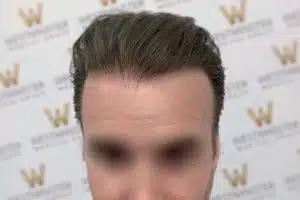 Close-up photo of a person's forehead and slicked-back hairstyle, likely addressing male pattern baldness, against a backdrop with a repeated "w" logo pattern. The person's eyes and lower face