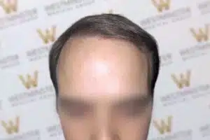 Close-up photo of a person's forehead and hairline, showing signs of male pattern baldness, with a blurred background featuring a repeated "w" logo. The face below the eyes is blurred out