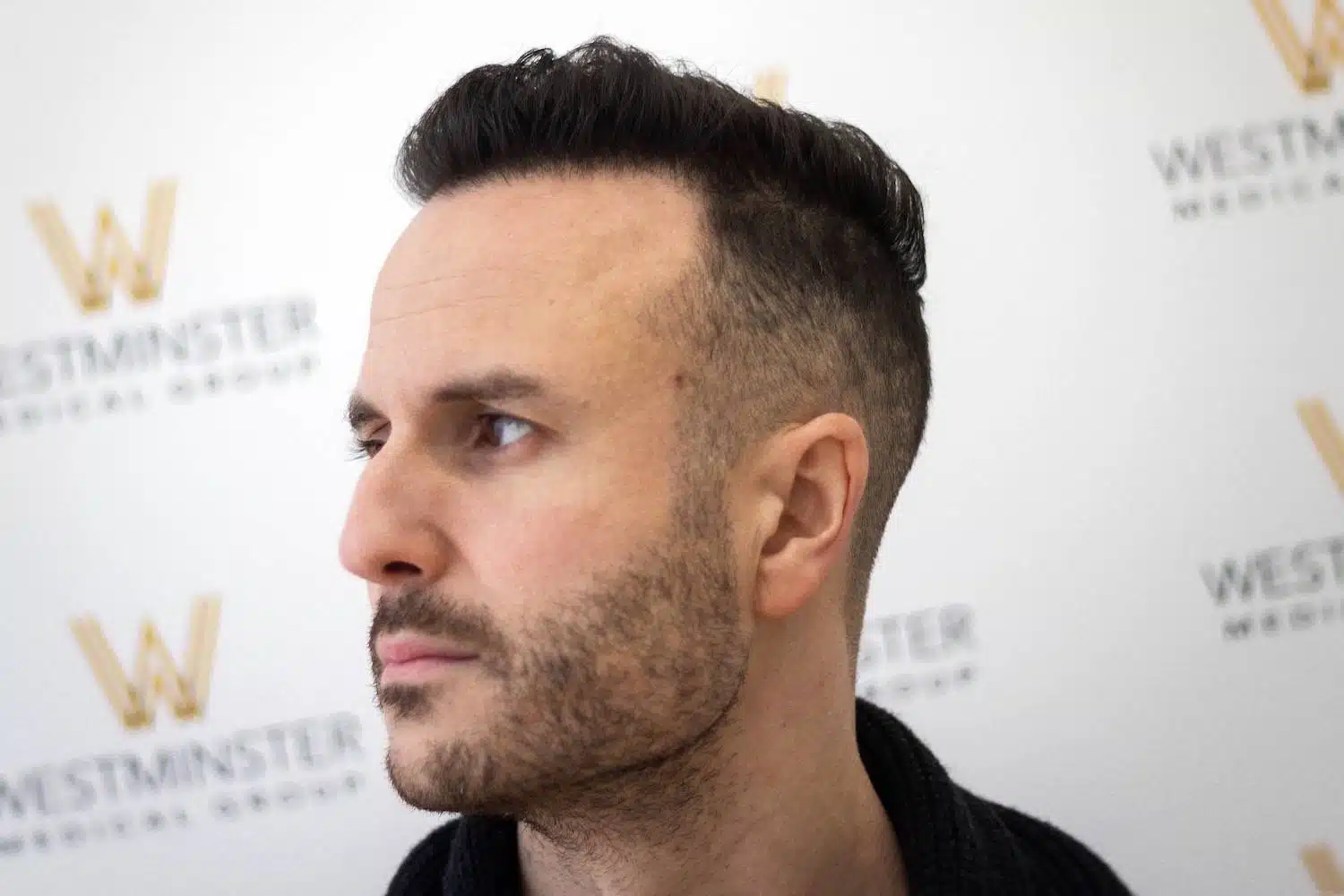 Side profile view of a male patient displaying a thick, restored hairline and styled hair after surgery