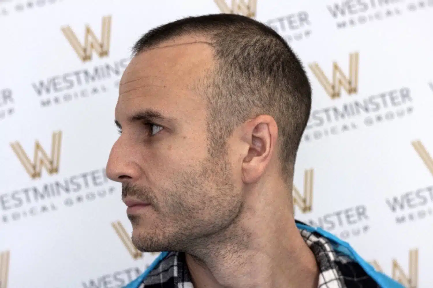 Side profile view of a male patient showing receding hairline markings before treatment by a hair transplant surgeon London