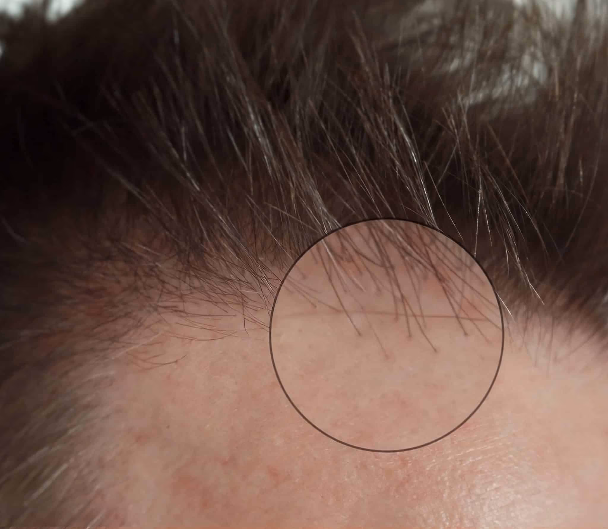 Close-up of a human scalp with thinning hair due to female hair loss, showing visible skin and a few strands within a highlighted circle.