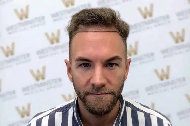 A man with light stubble and hair regrowth, giving a subtle smile, wearing a striped shirt, in front of a wall with a repetitive 'w' logo pattern.