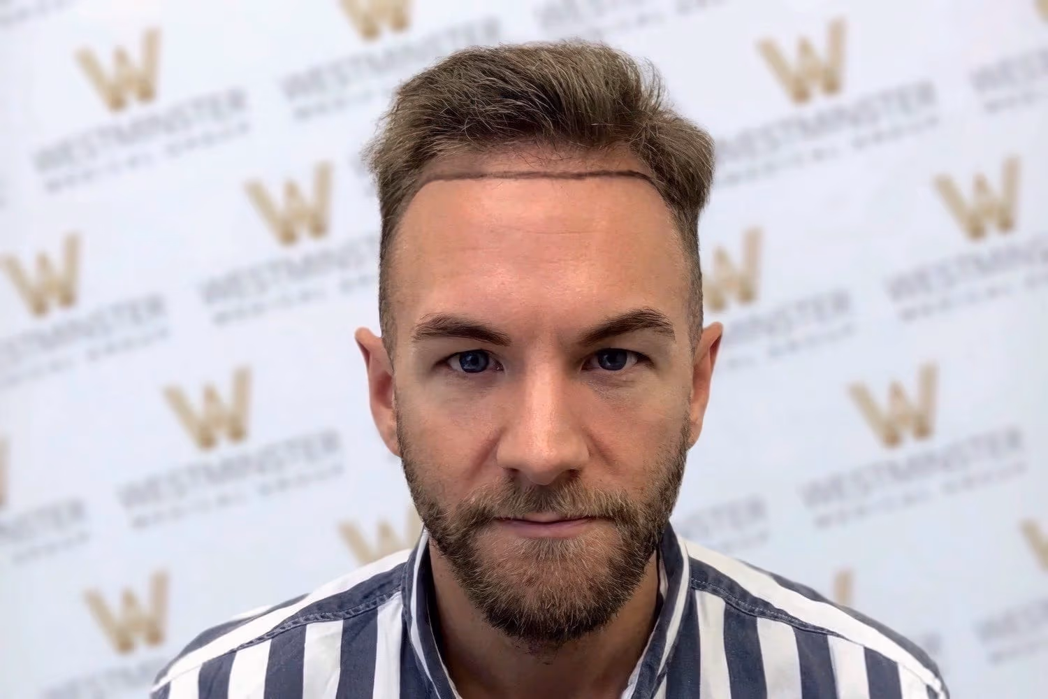 A man with light stubble and hair regrowth, giving a subtle smile, wearing a striped shirt, in front of a wall with a repetitive 'w' logo pattern.