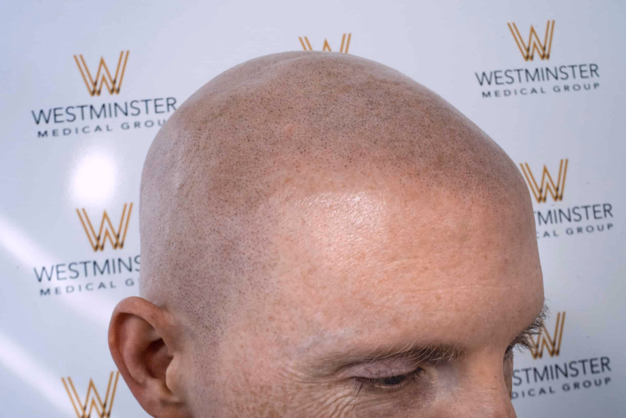 Close-up view of the top of a bald man's head with visible hair follicles against a backdrop with the Westminster Medical Group logo, specializing in hair replacement.