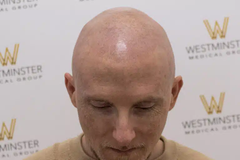 Close-up of a bald man's head looking downward, with a background featuring a blurred logo of Westminster Medical Group specializing in hair replacement.