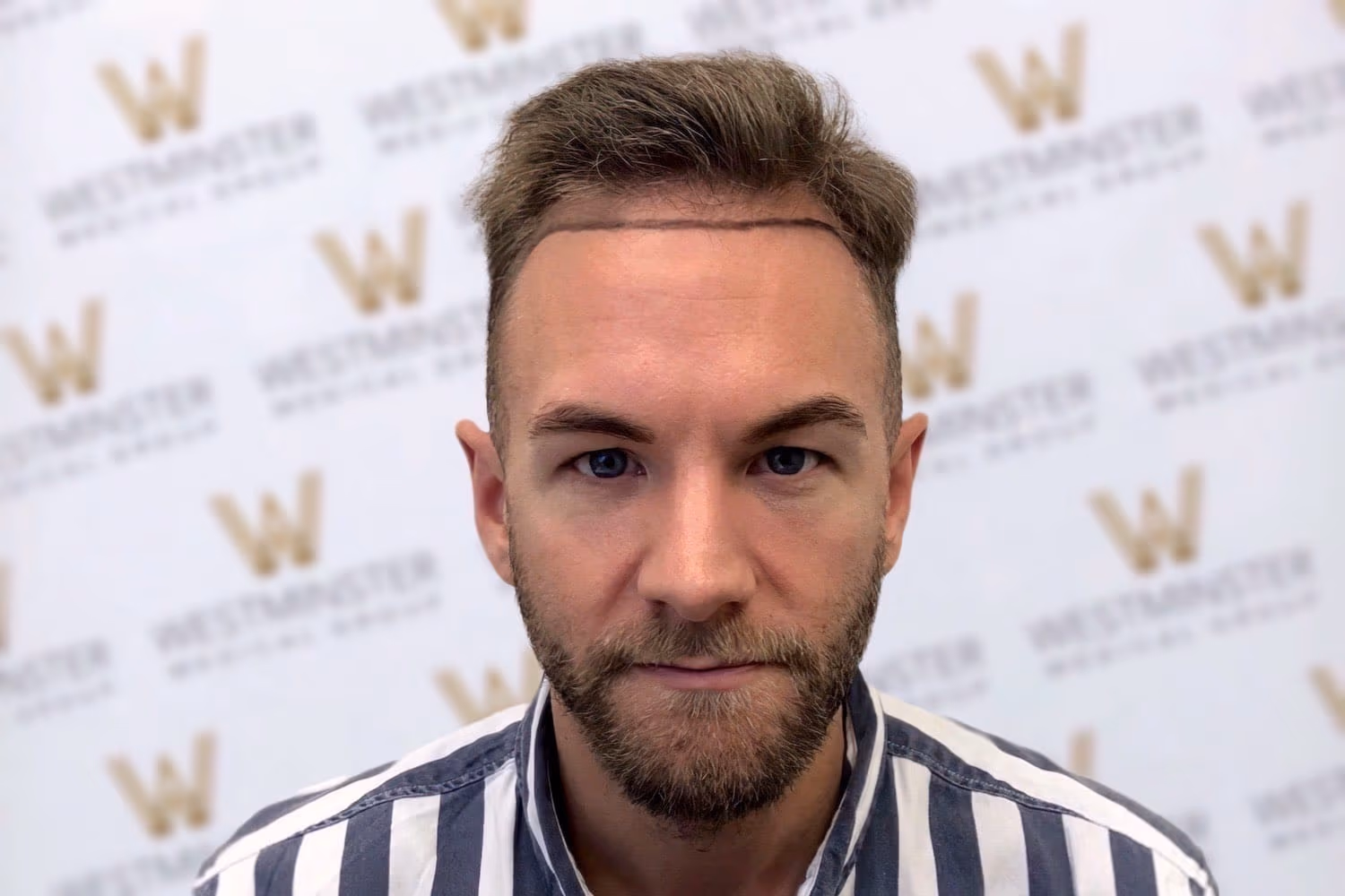 Frontal view of a male patient with a newly drawn hairline preparing for treatment at a CQC regulated clinic