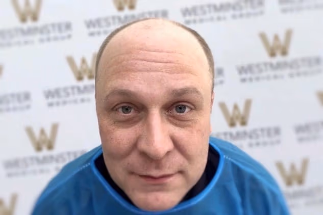 A man with hair regrowth and wearing a blue shirt sits in front of a backdrop with the Westminster logo repeated across it. He is looking directly at the camera with a neutral expression.