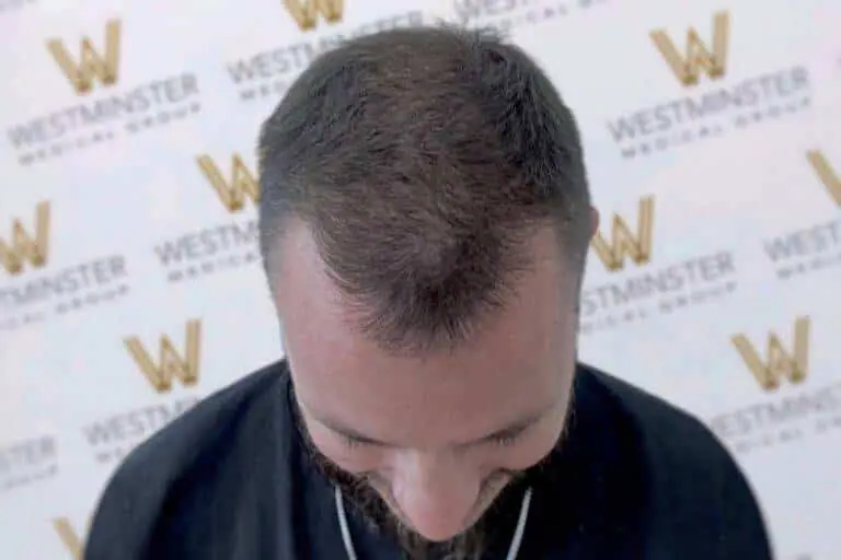 Top view of a person's head showcasing early stages of male pattern baldness with thinning hair on the crown against a backdrop with the Westminster logo.