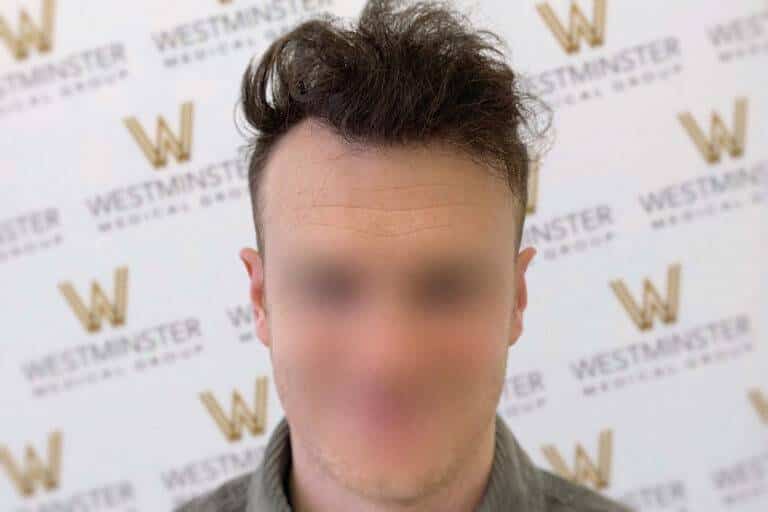 Man with blurred face against a backdrop with "westminster" logos, featuring dark, tousled hair and a grey sweater, possibly experiencing male pattern baldness.