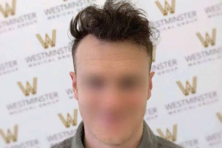 Man with blurred face against a backdrop with "westminster" logos, featuring dark, tousled hair and a grey sweater, possibly experiencing male pattern baldness.