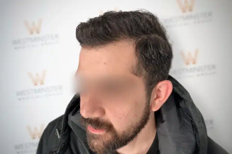 Side profile view of a male patient demonstrating full hair growth and natural hairline restoration results