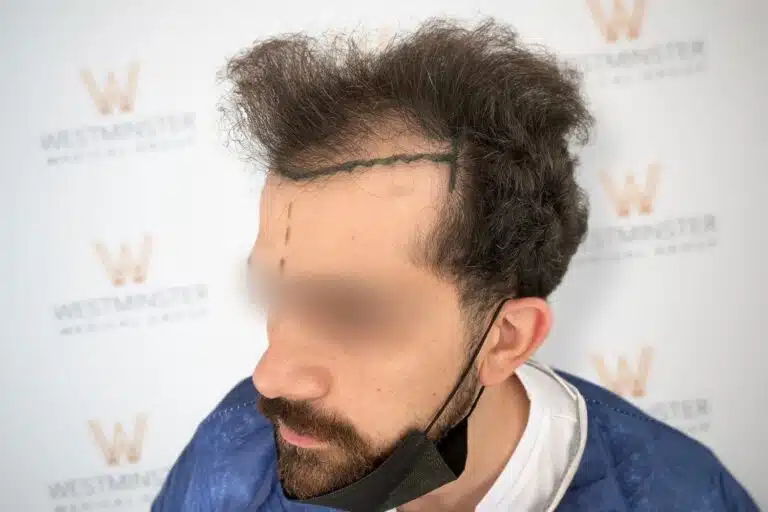 Side profile view of a male patient with surgical markings along the frontal hairline preparing for procedure
