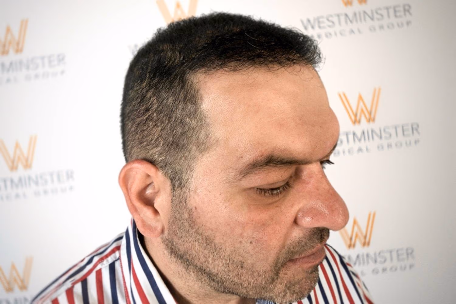 Side profile view of a male patient showcasing full scalp coverage at a CQC regulated facility