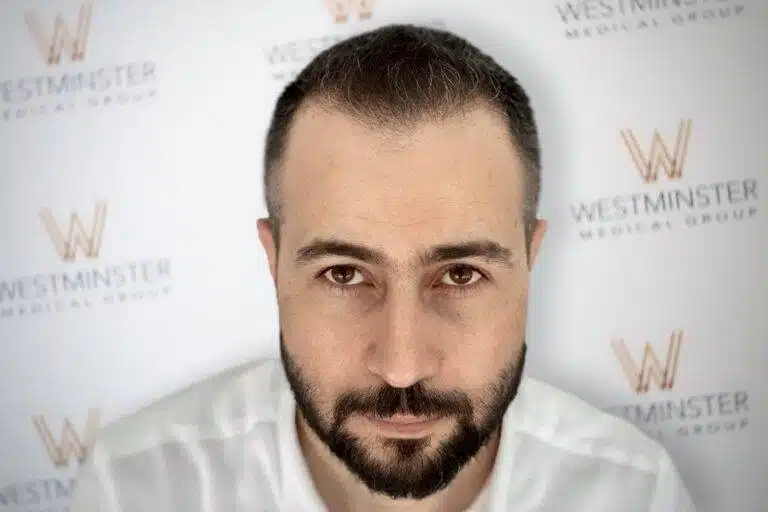 Frontal view of a bearded male patient with restored hairline density detailing hair transplant finance options