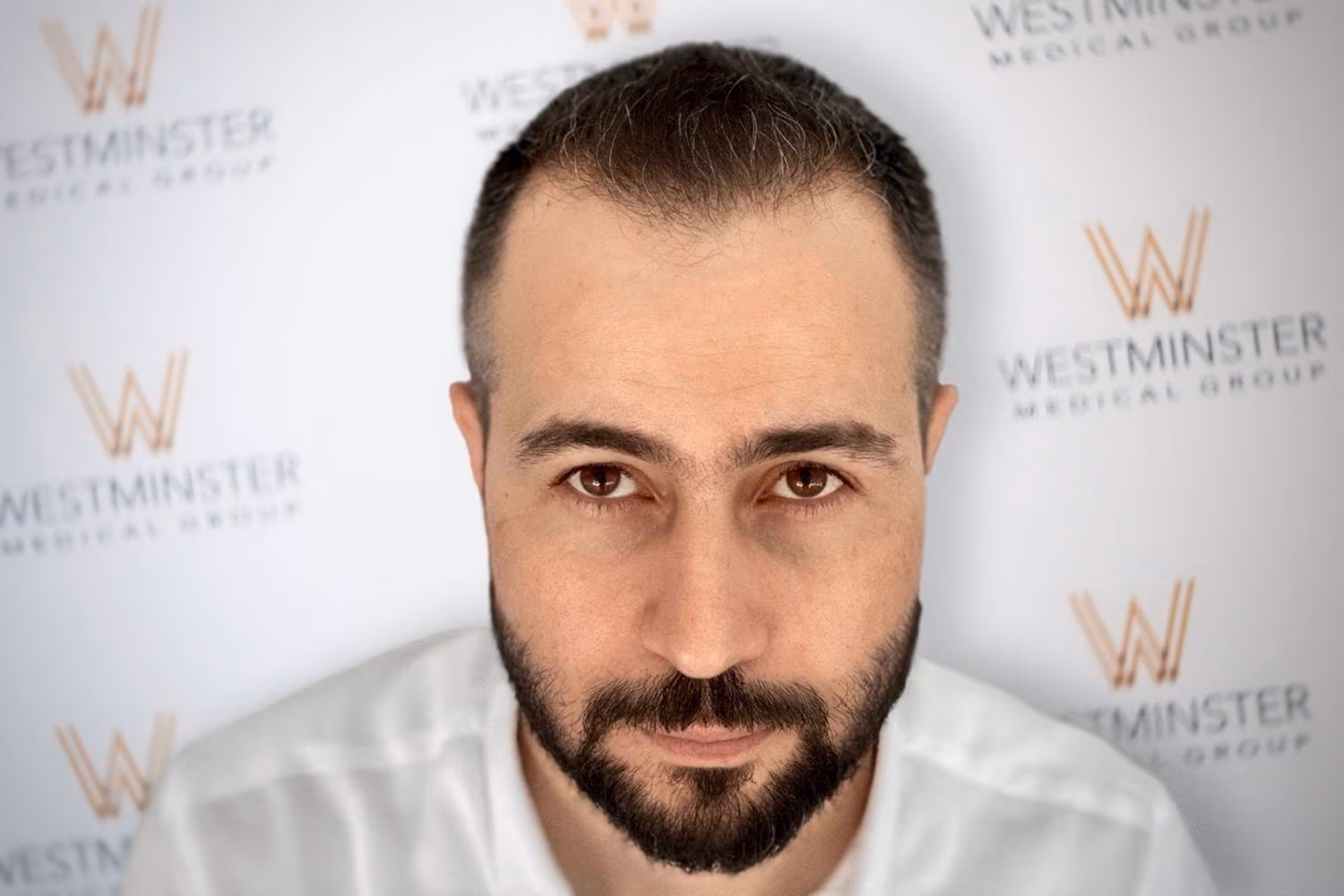 Frontal view of a bearded male patient with restored hairline density detailing hair transplant finance options