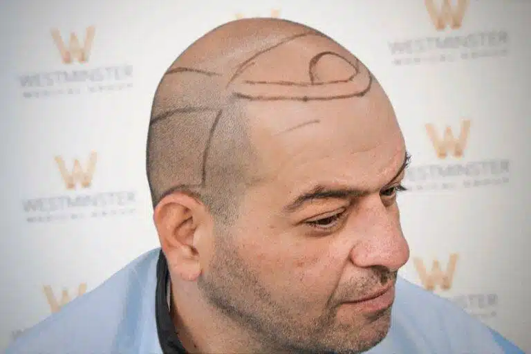 Side profile view of a shaved male patient with surgical head markings before treatment by GMC-registered surgeons
