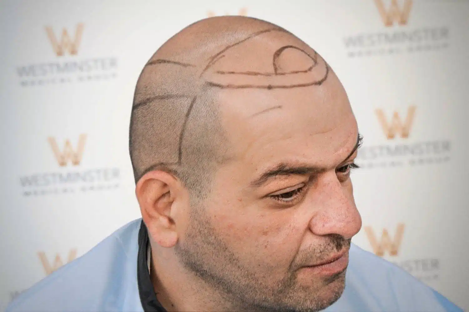 Side profile view of a shaved male patient with surgical head markings before treatment by GMC-registered surgeons