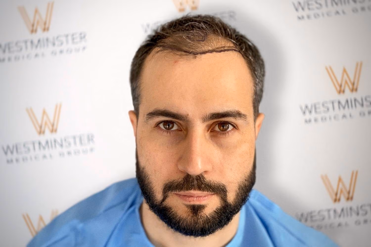 Frontal view of a bearded male patient in a surgical gown before a Hair Transplant London procedure