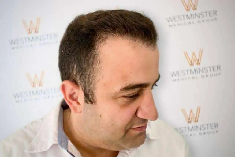 Three-quarter angle view of a male patient showcasing restored hairline density and natural-looking hair growth