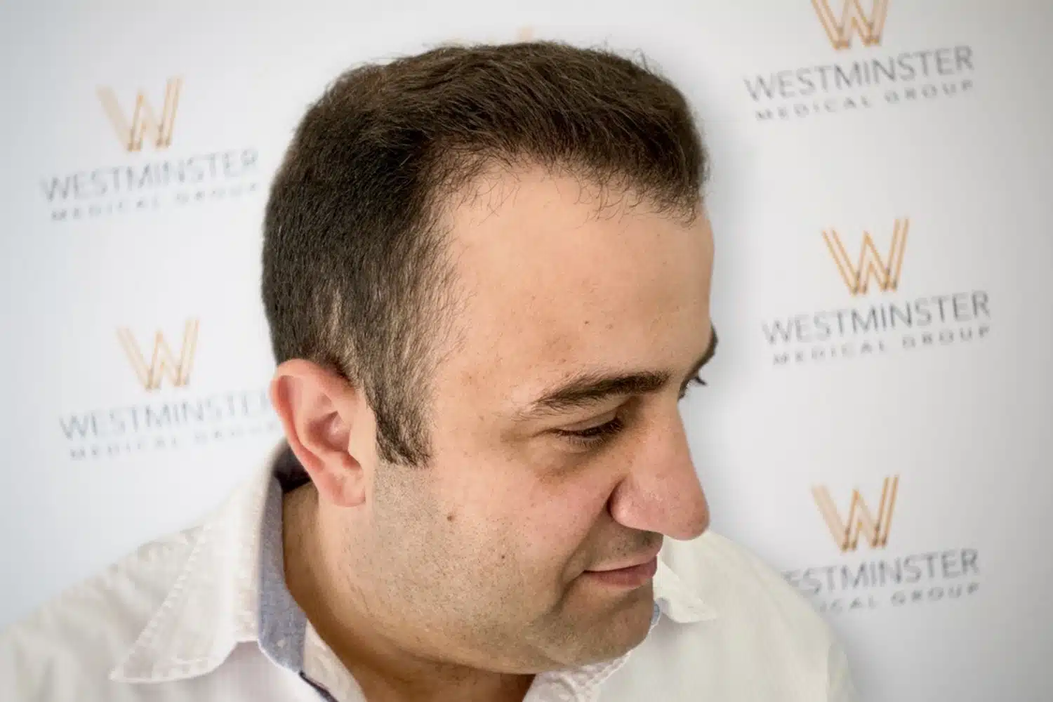 Three-quarter angle view of a male patient showcasing restored hairline density and natural-looking hair growth