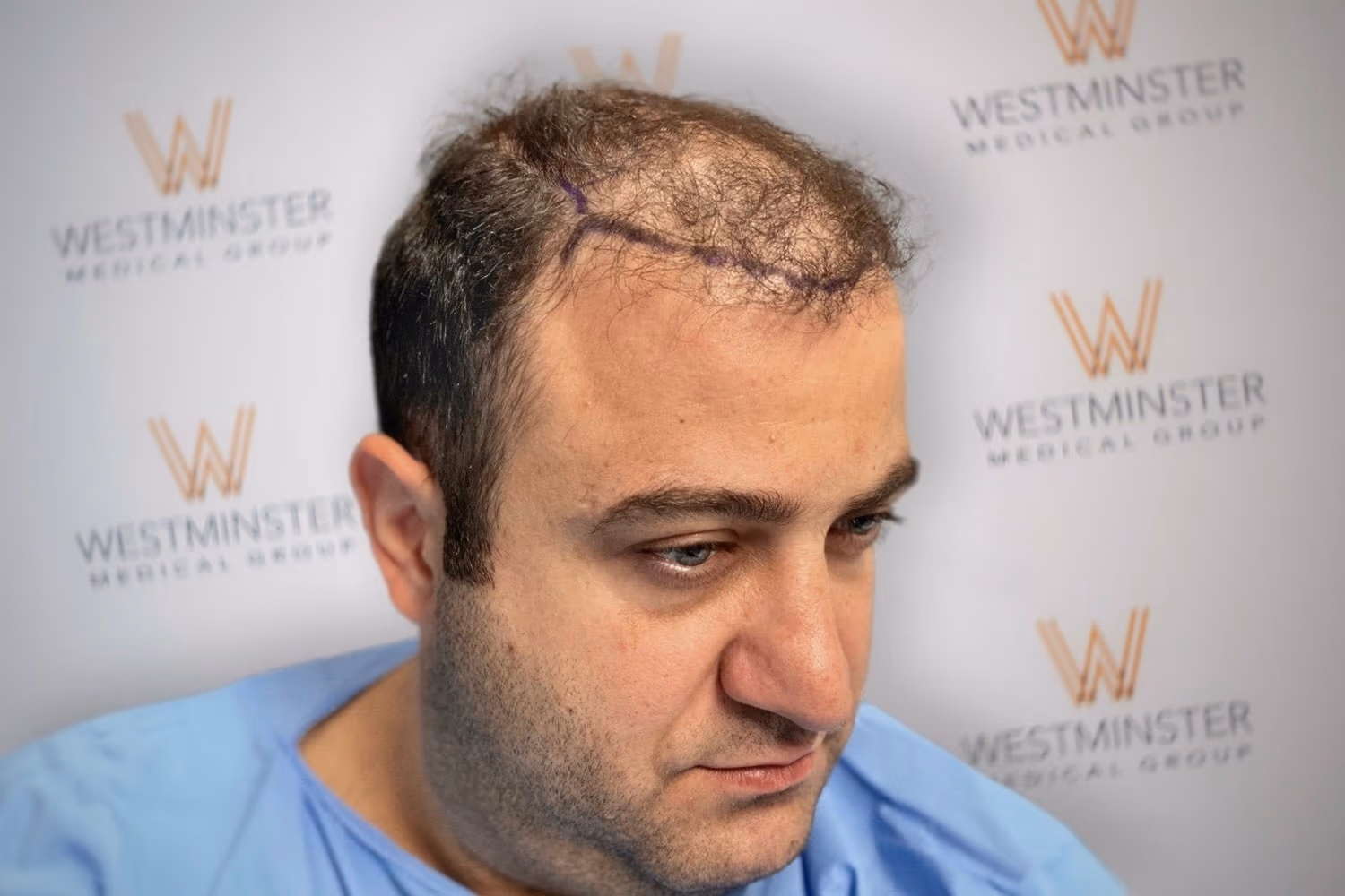 Three-quarter angle view of a male patient showing receding hairline and surgical grid markings prior to treatment