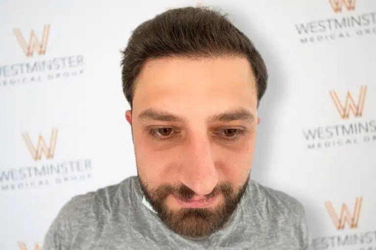Frontal view of a bearded male patient with full, dense hairline coverage after procedure