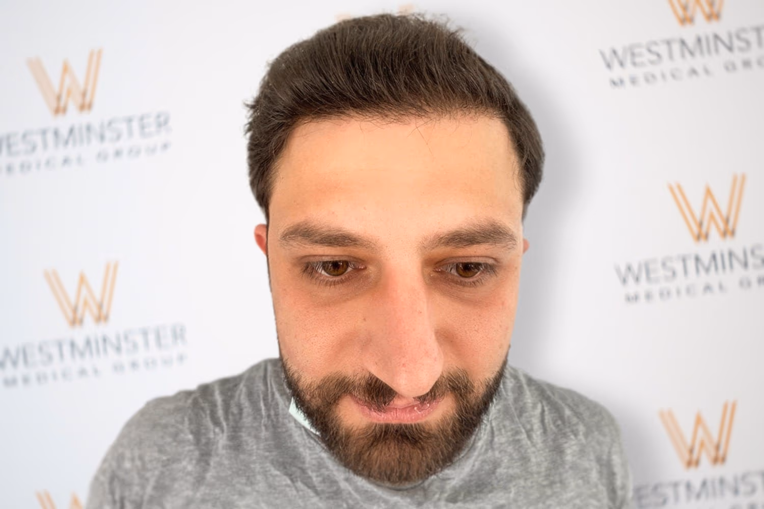 Frontal view of a bearded male patient with full, dense hairline coverage after procedure