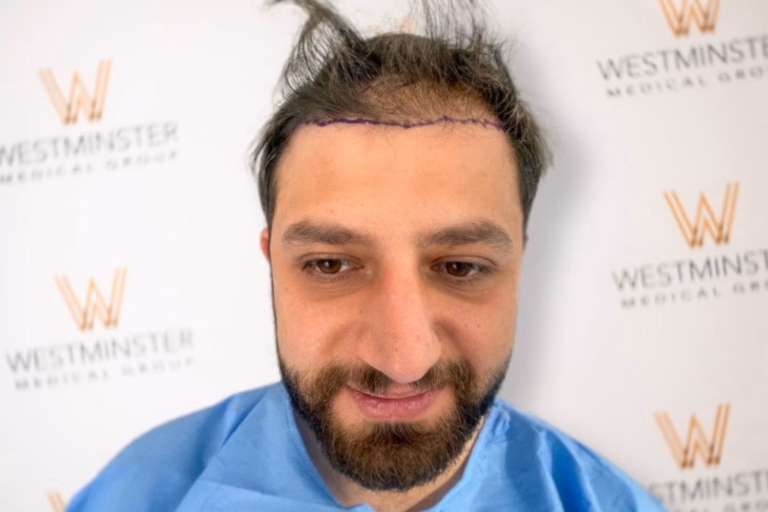 Frontal view of a bearded male patient in a surgical gown showing immediate post-op hairline markings for FUE hair transplant cost