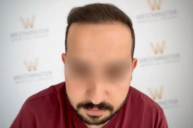 WMG-Hair-Transpant-London-After-1A - Westminster Medical Group®
