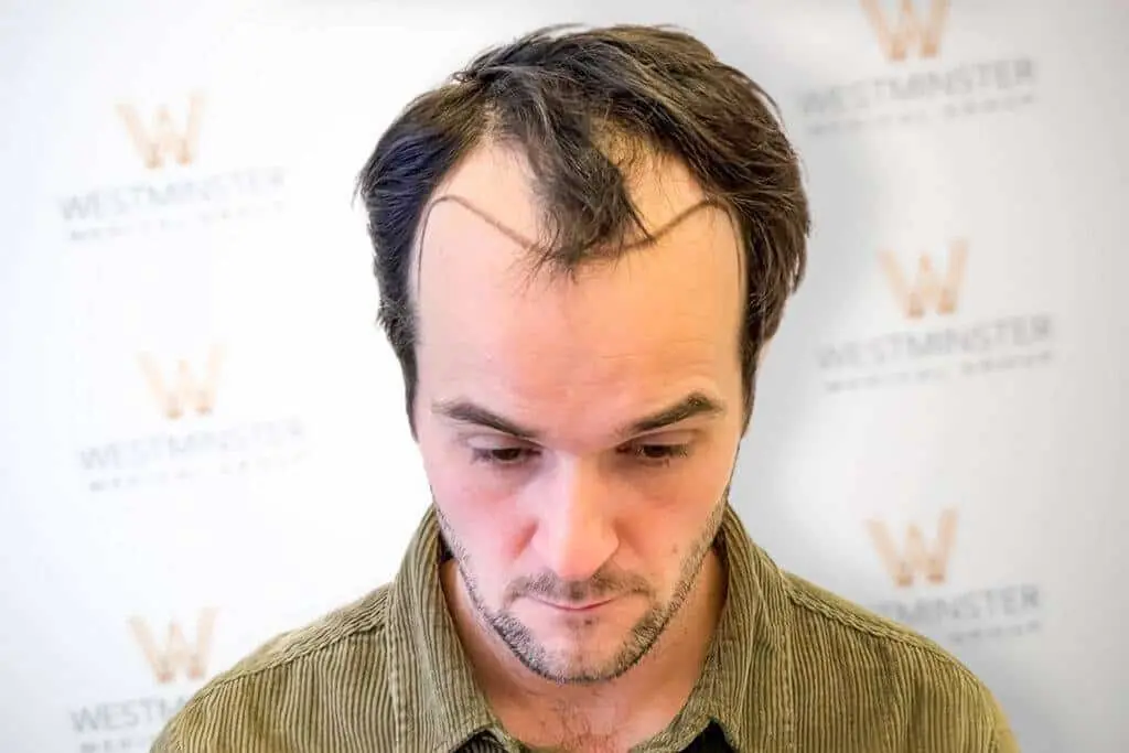 Top-down view of a male patient displaying receding temples and hairline recession prior to treatment