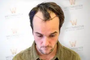 Top-down view of a male patient displaying receding temples and hairline recession prior to treatment