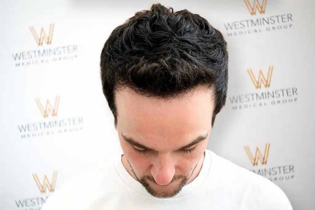 Top-down view of a male patient showing successful full hair coverage following procedure