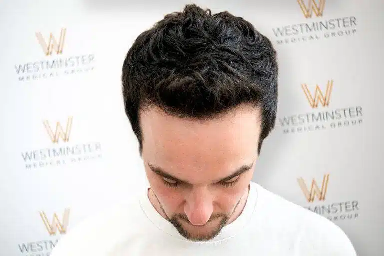 Top-down view of a male patient showing successful full hair coverage following procedure