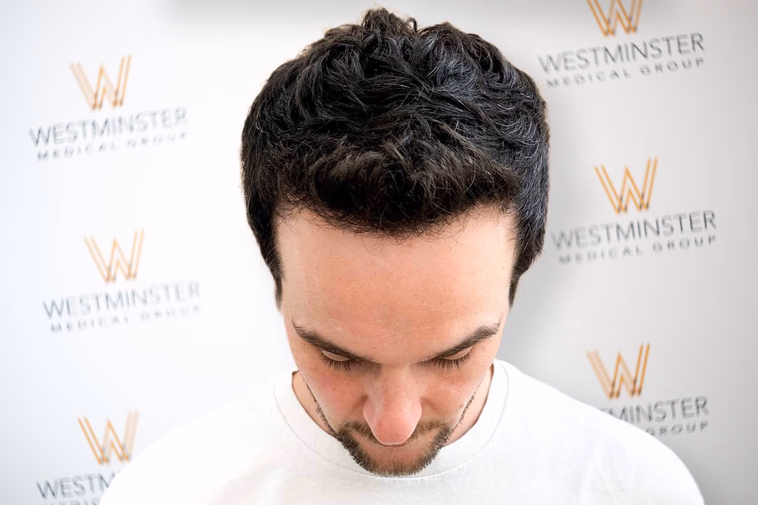 Top-down view of a male patient showing successful full hair coverage following procedure