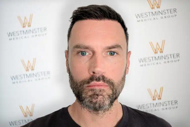 Frontal view of a bearded male patient with dense hair coverage showcasing Hair Transplant Cost London outcomes