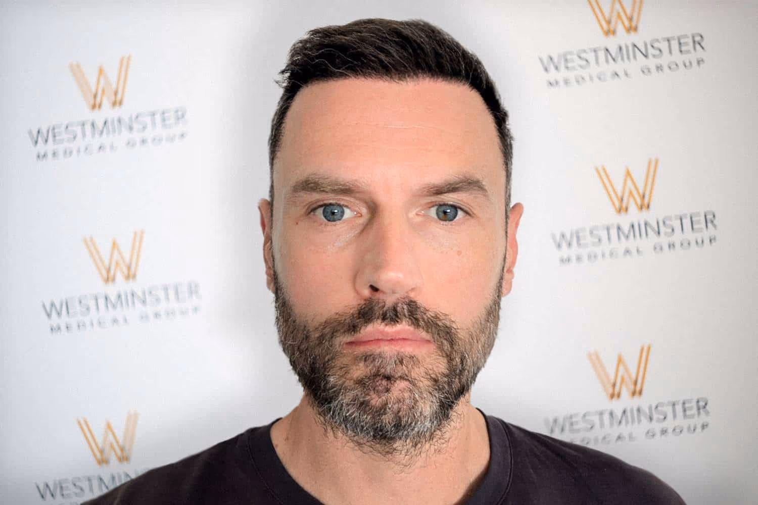 Frontal view of a bearded male patient with dense hair coverage showcasing Hair Transplant Cost London outcomes