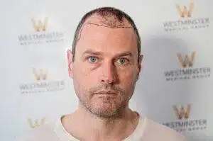 Frontal view of a male patient with close-cropped hair and visible post-procedure markings along the hairline