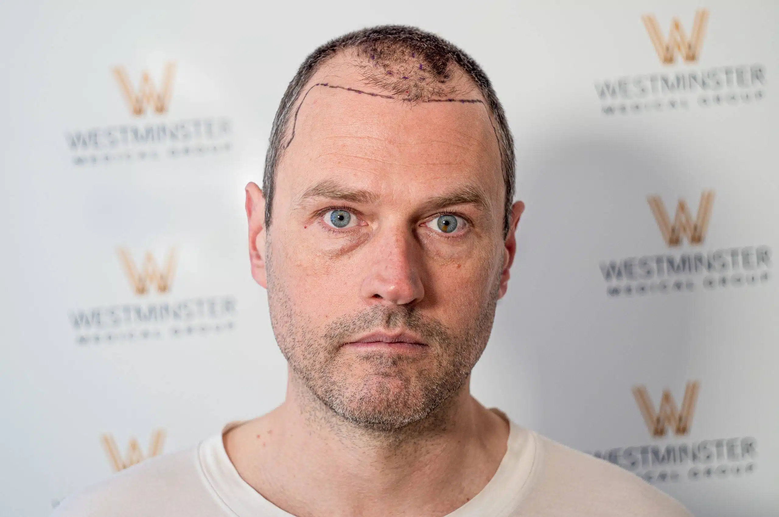 Frontal view of a male patient with close-cropped hair and visible post-procedure markings along the hairline