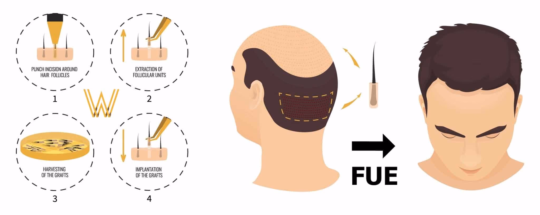 FUE-Hair-Transplant-Westminster-Medical-Group.jpg