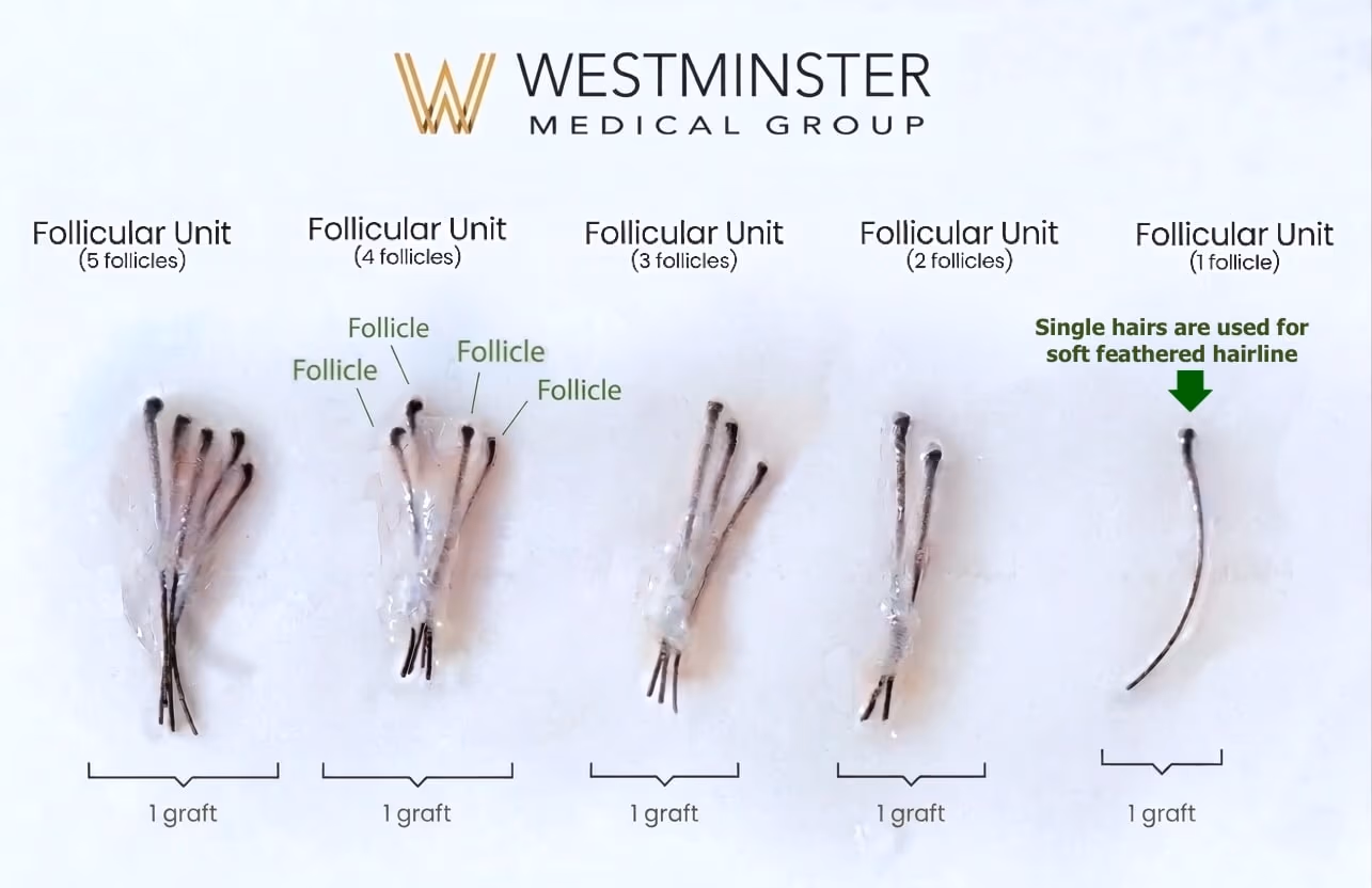 Soft feathered natural hairline recreation using fine calibre hairs