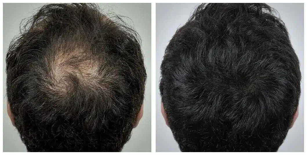 Finasteride before & after result