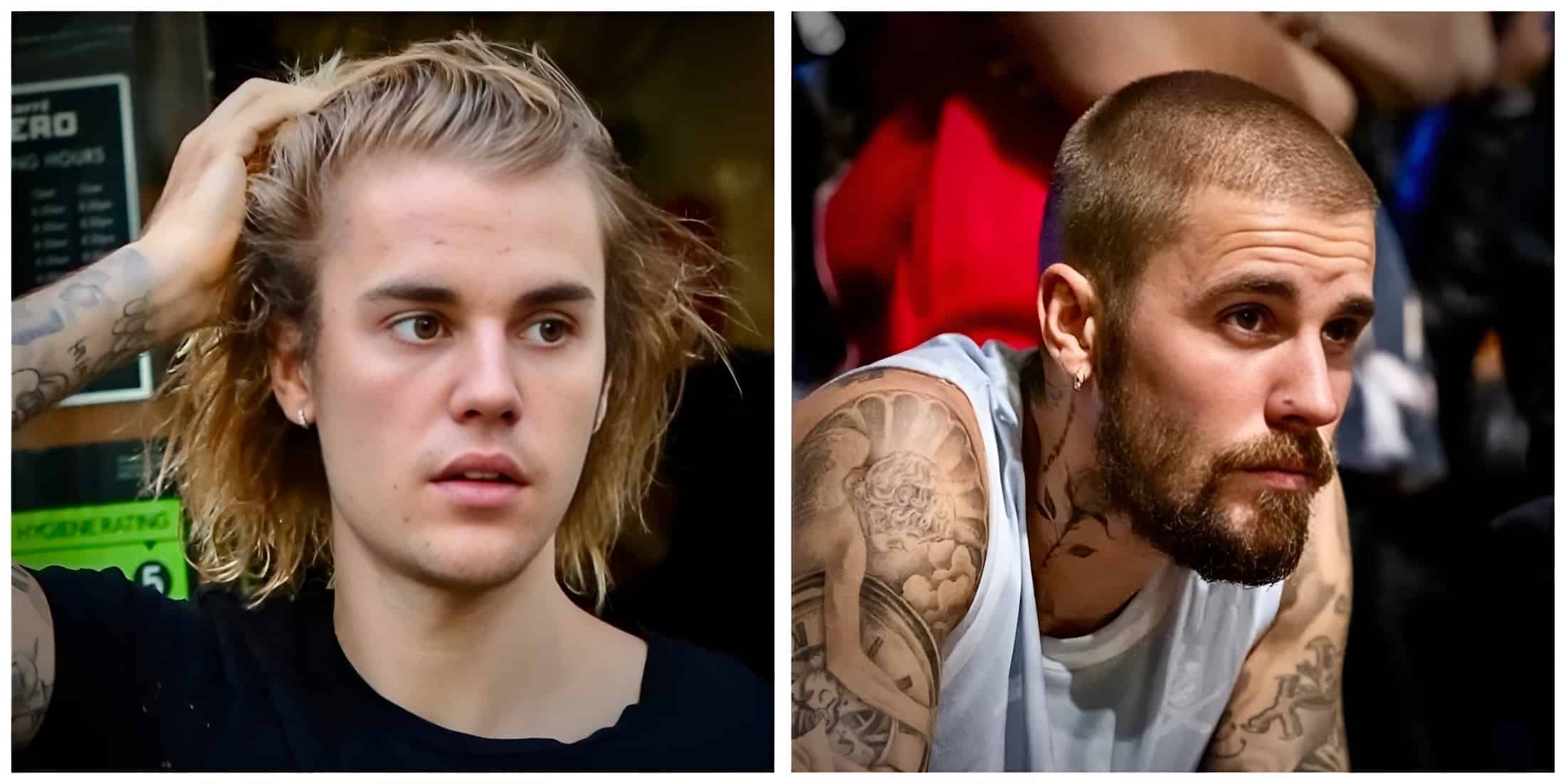 A picture of Justin Bieber with hair loss and hair restoration