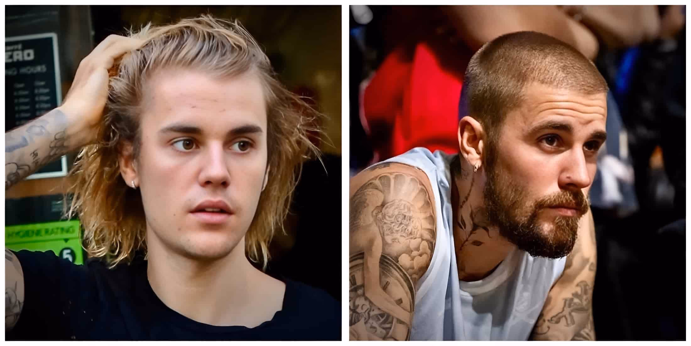 A picture of Justin Bieber with hair loss and hair restoration