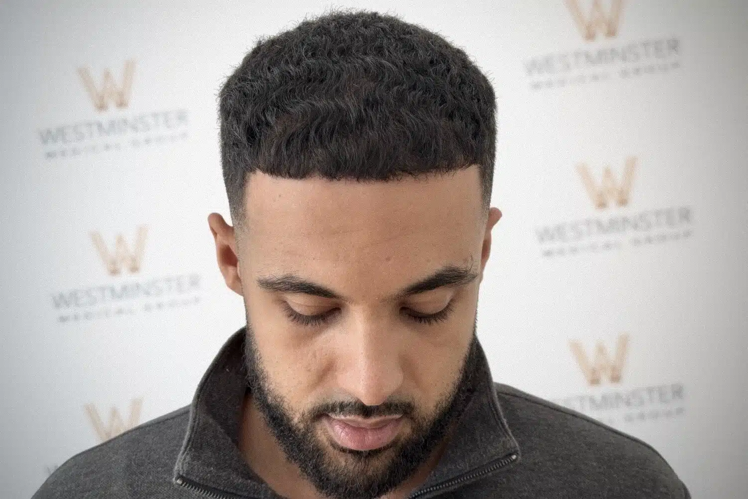 Top view of a male patient with curly hair showing full density restoration and clear UK hair transplant prices results